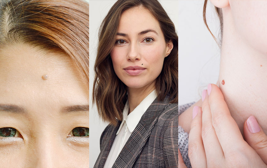 Which moles are considered lucky?